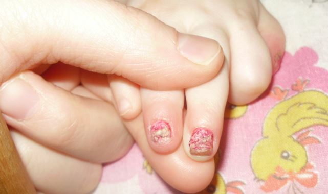 Çocuğunuzun sağlık durumu tırnaklarına yansıyabilir