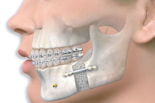 İzmir Çene Cerrahisi