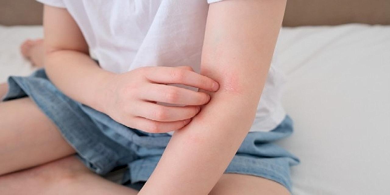 Çocuklarda 'Alerjik Hastalıklar' Hakkında Doğru Sanılan 8 Hatalı Bilgi!