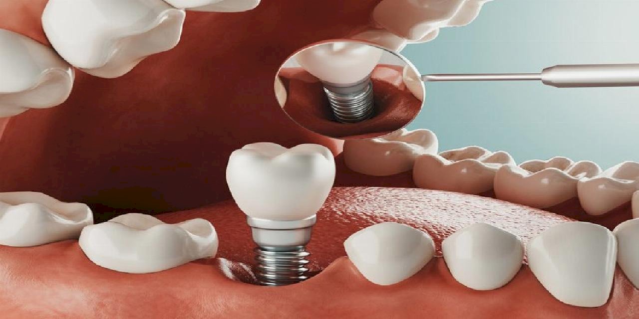 Diş tedavisinde implant zorlu bir süreç mi?