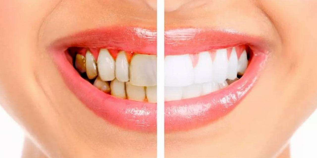 Diş taşı temizliğinin zararı var mı?