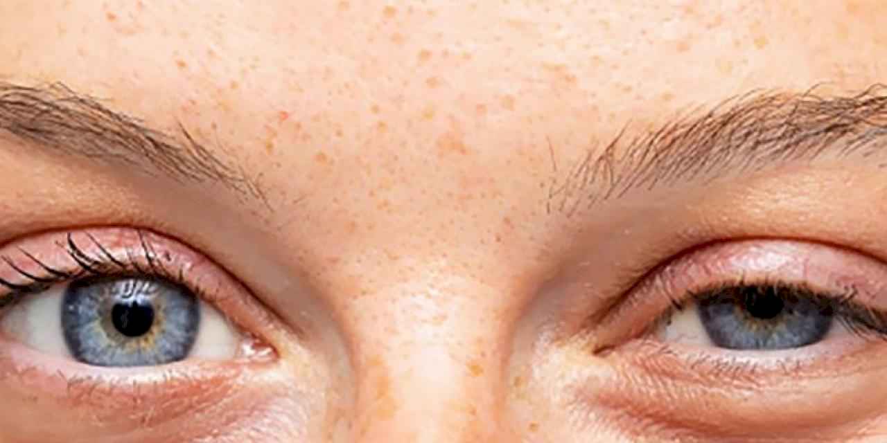 Düşük göz kapağı kaderiniz değil!