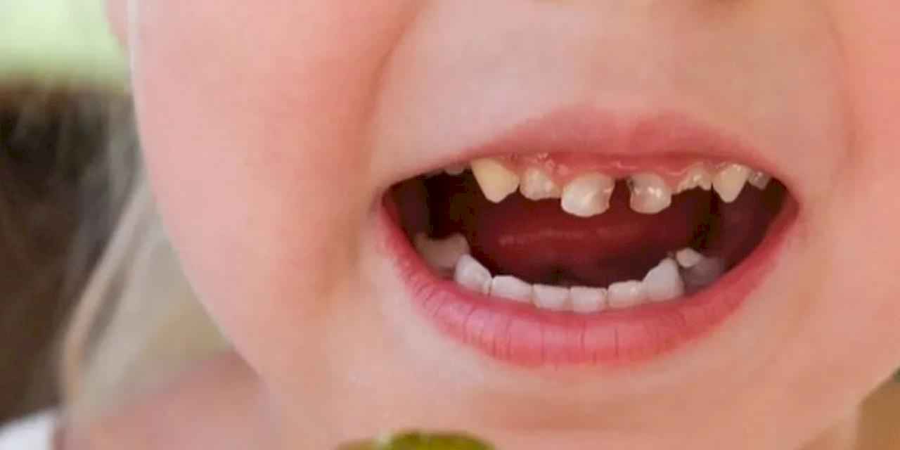 Çocuklarda çürük diş riskine dikkat!