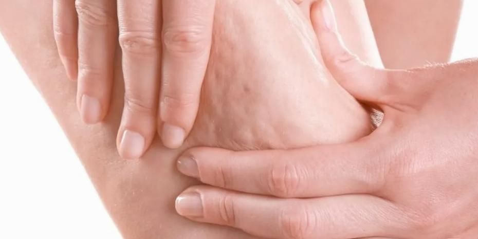 Prof. Dr. Karacalar’dan selülit uyarısı: Portakal kabuğu görüntüsü basit sorun değil!