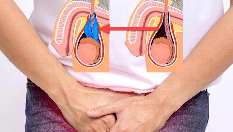 Erkeklerde varikosel sorununa dikkat!