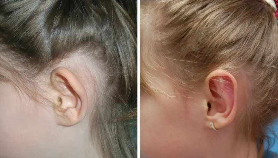 Kepçe kulakta ameliyatsız tedavi yenidoğan döneminde mümkün